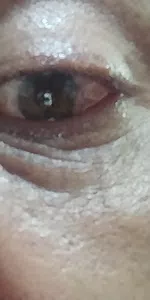 Irritación en el ojo por salpicadura del liquido de la capsula