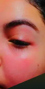 El corrector de ojeras me hizo daño en la piel