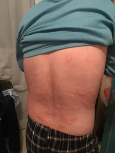 Pruebas cutáneas