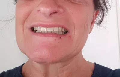 Dos implantes colocados en swiss medical frontales, de diferente color