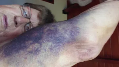 Lesiones debido a frenada brusca