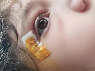 Mi hija de 7 años se cayo del pelotero y corto al lado del ojo. la cosieron