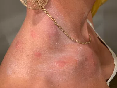 Picaduras de bedbugs en el avión de latam