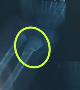 Fractura de radio no diagnosticada en guardia pediátrica