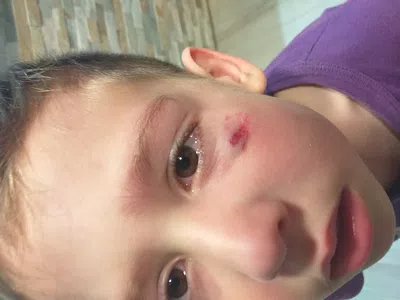 Por defecto en colchon casi mi hijo se saca el ojo